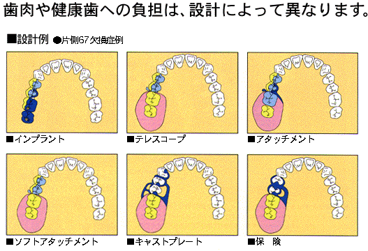 入れ歯について