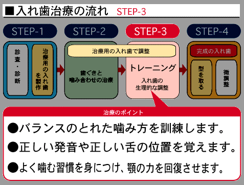 入れ歯について