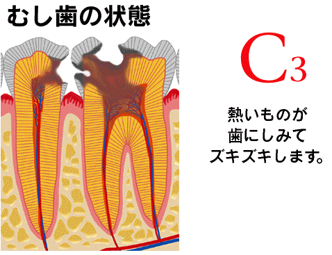 なぜ虫歯になるの？？