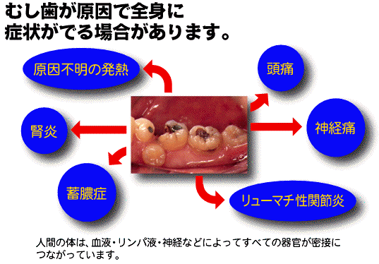 なぜ虫歯になるの？？