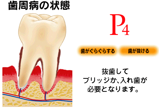 歯槽膿漏