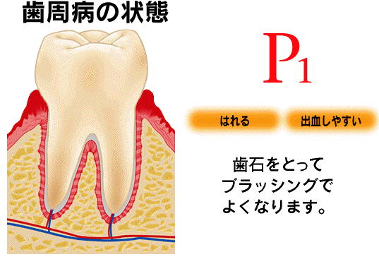 歯槽膿漏