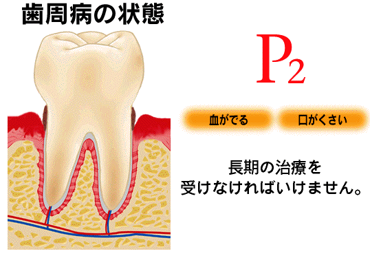 歯槽膿漏