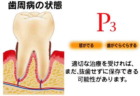 歯槽膿漏