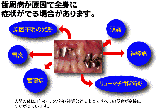 歯槽膿漏