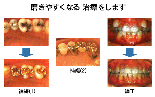 プラークコントロール